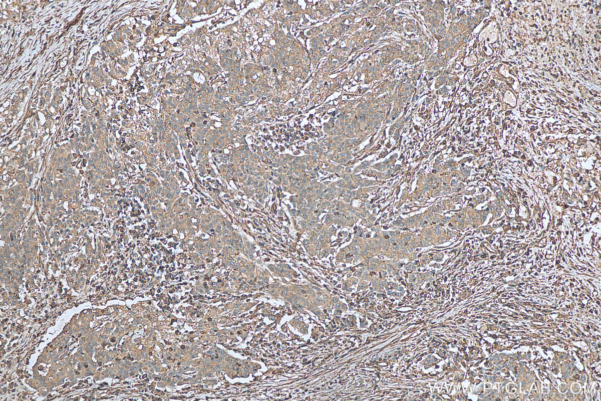 IHC staining of human stomach cancer using 66196-1-Ig (same clone as 66196-1-PBS)
