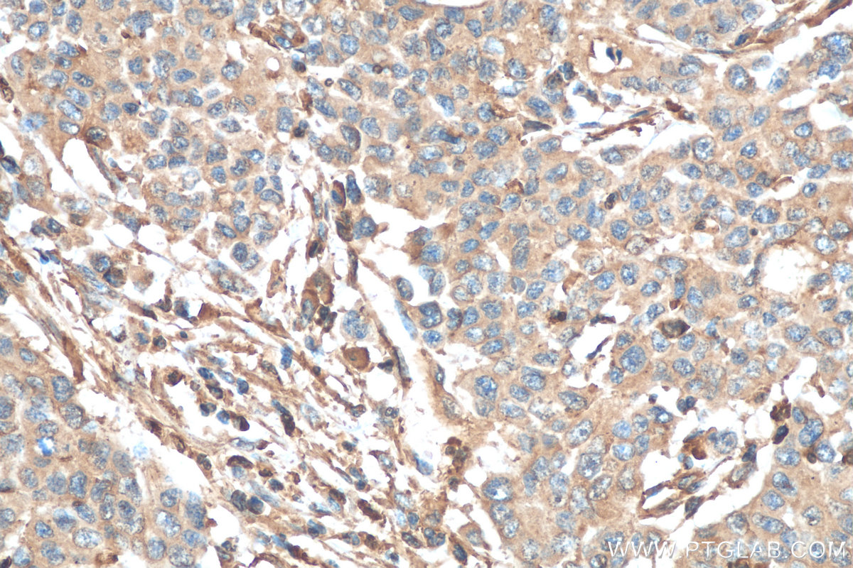 IHC staining of human stomach cancer using 66196-1-Ig