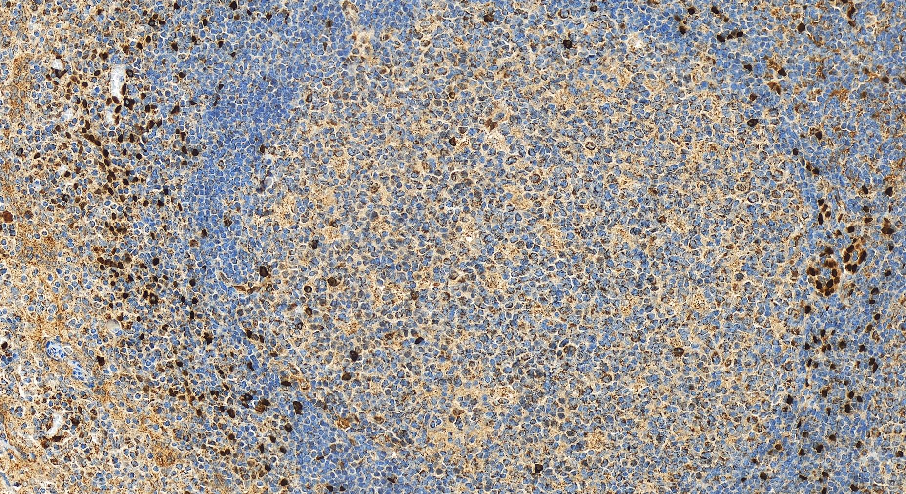 IHC staining of human tonsillitis using 12372-1-AP