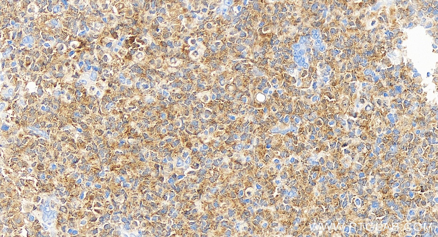 IHC staining of human tonsillitis using 83243-3-RR (same clone as 83243-3-PBS)