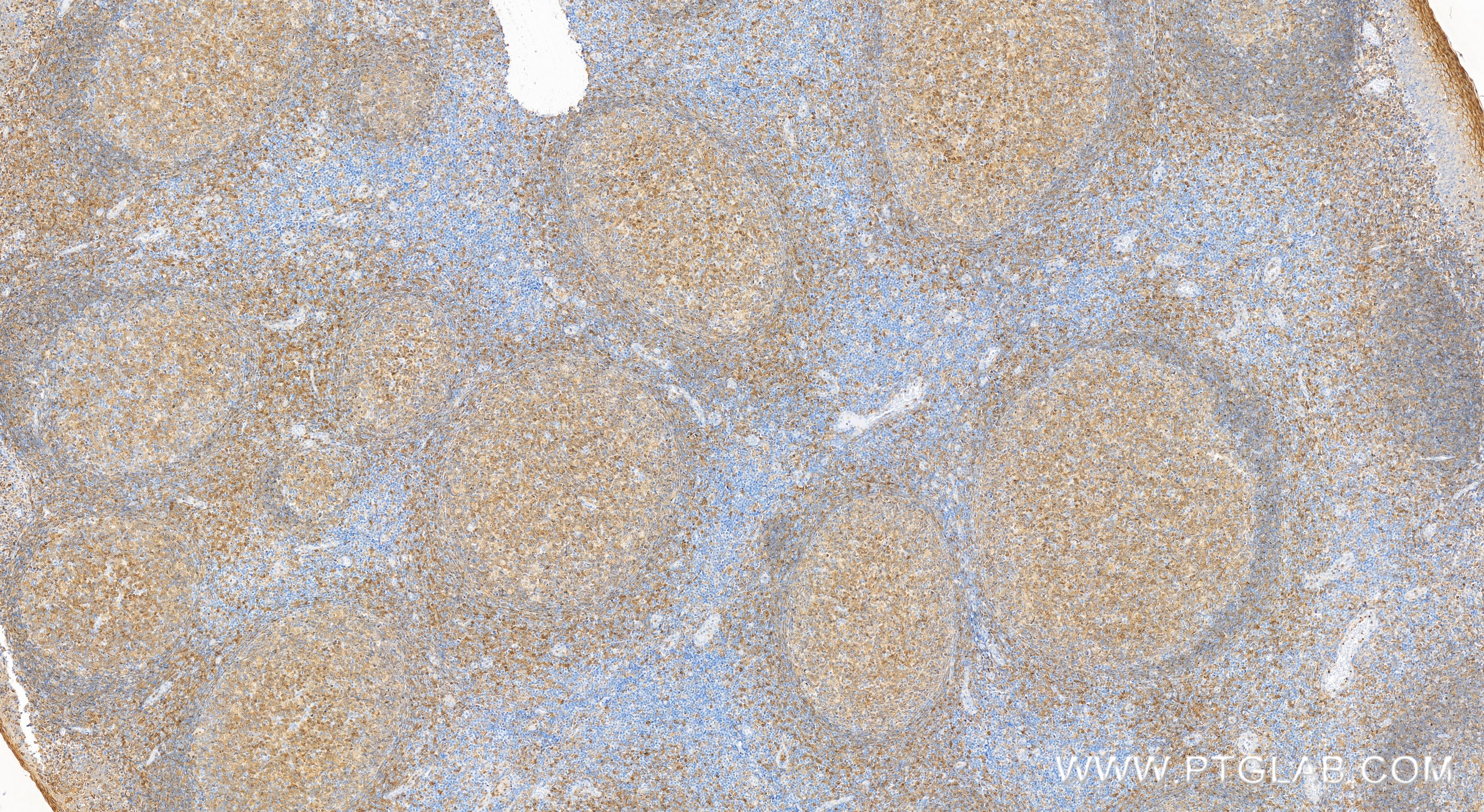 IHC staining of human tonsillitis using 83243-3-RR (same clone as 83243-3-PBS)