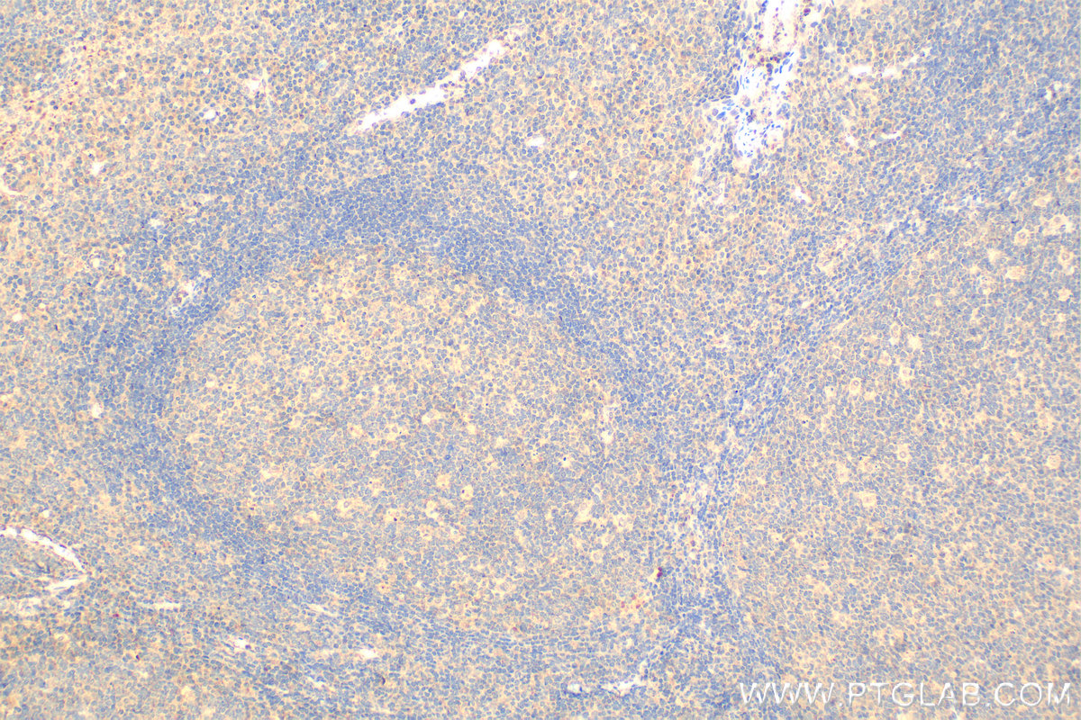 IHC staining of human tonsillitis using 66144-1-Ig