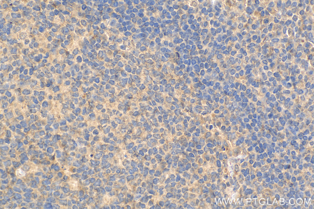 IHC staining of human tonsillitis using 66144-1-Ig