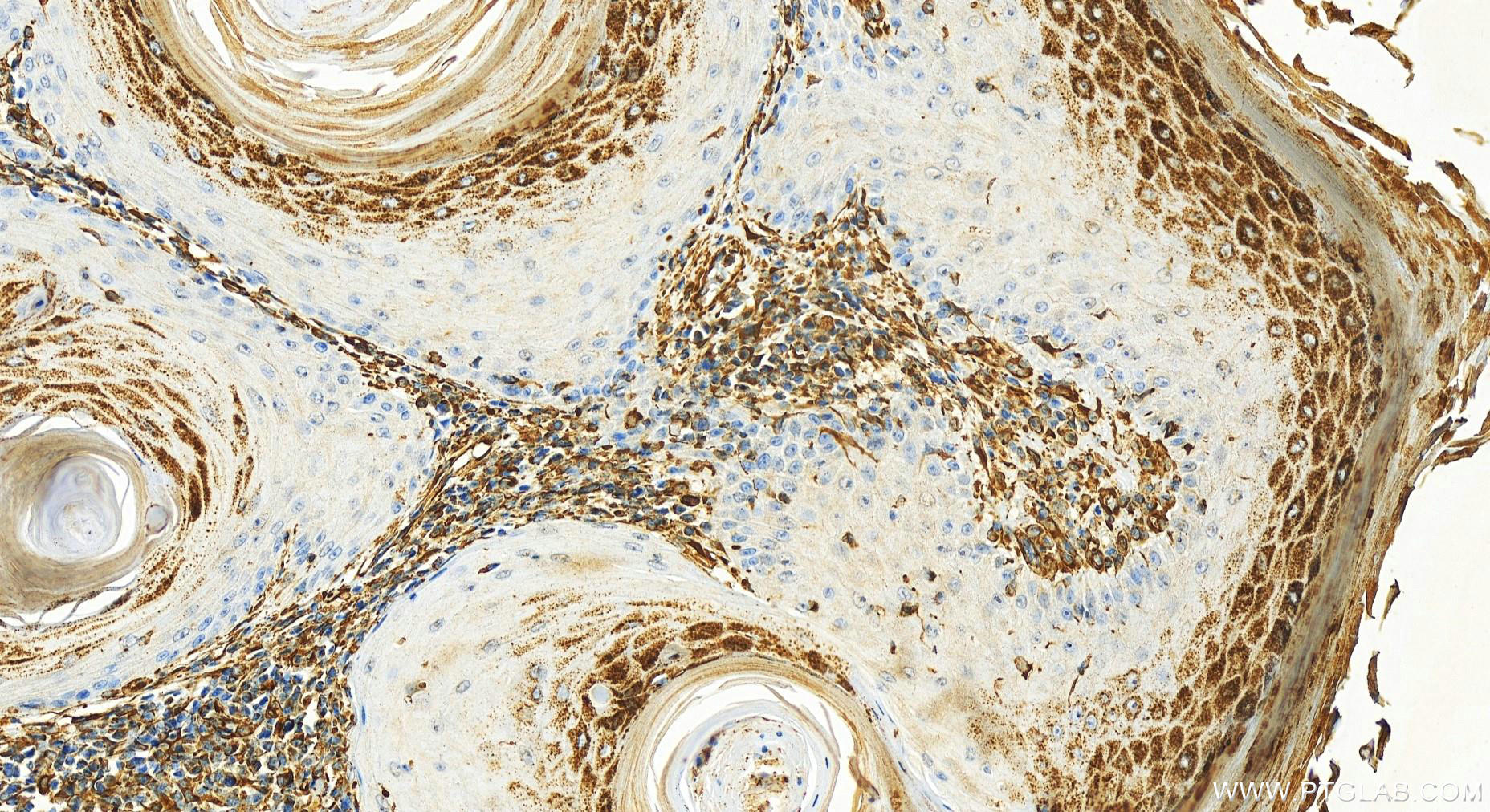 IHC staining of human skin cancer using 67724-1-Ig