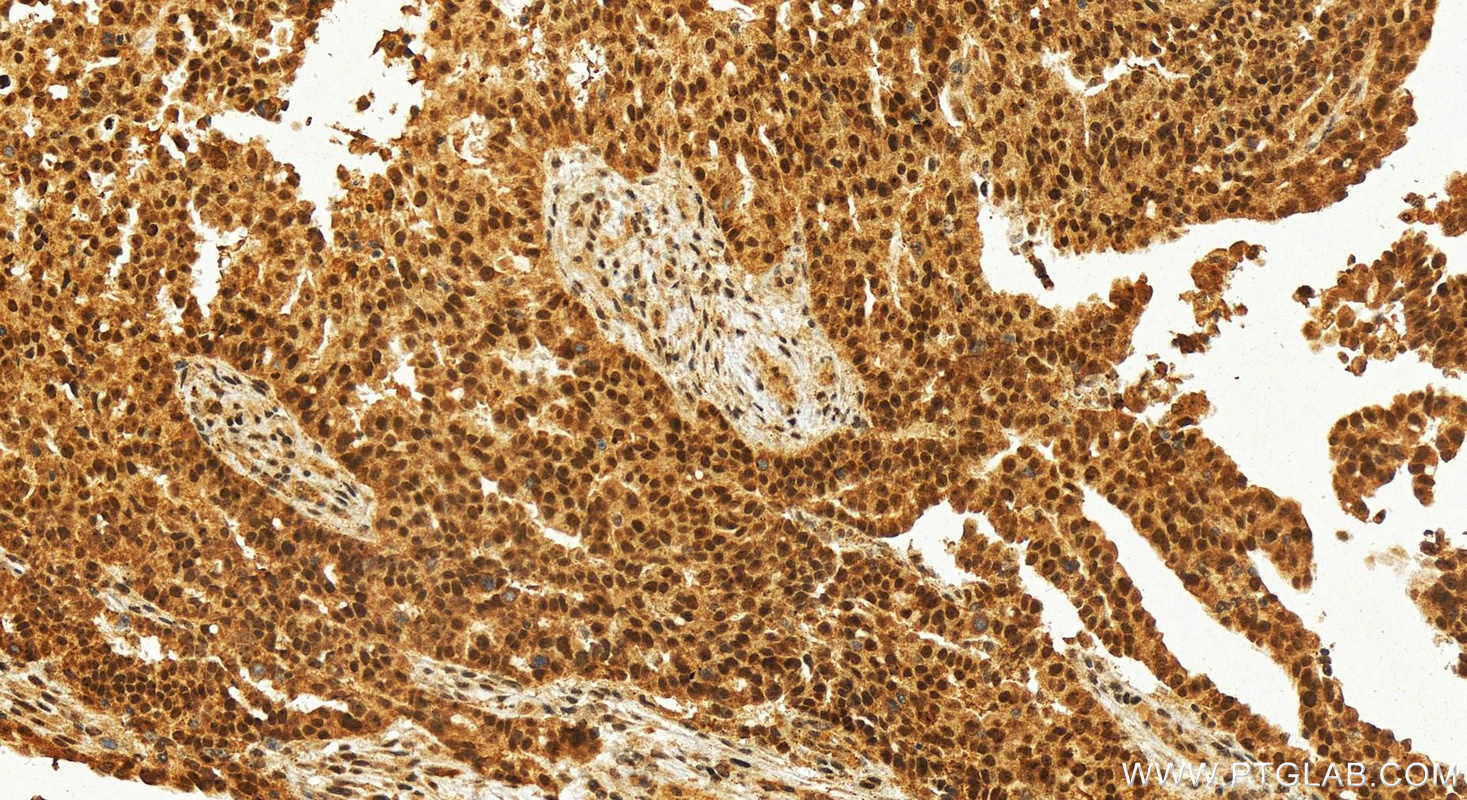 IHC staining of human ovary cancer using 12750-1-AP