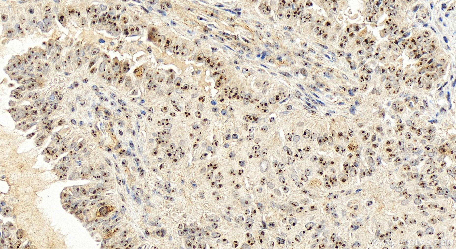 IHC staining of human ovary cancer using 16205-1-AP