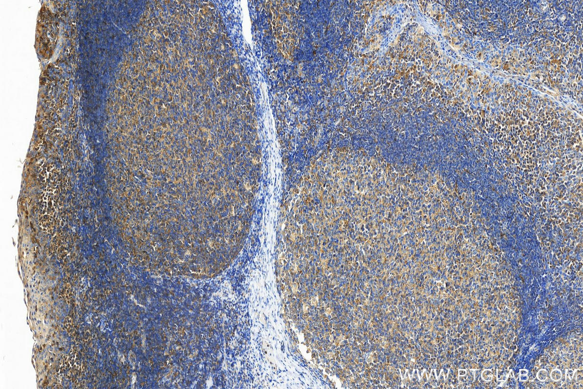 IHC staining of human tonsillitis using 22092-1-AP