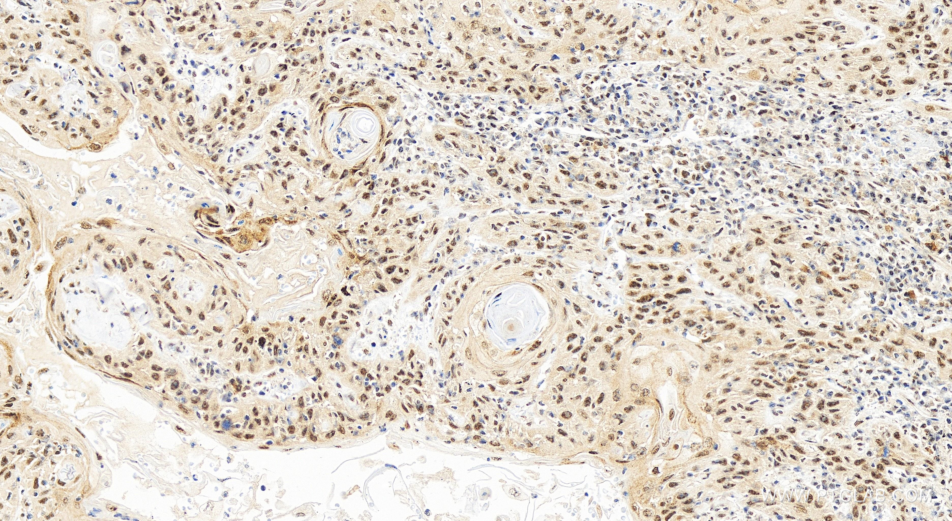 IHC staining of human skin cancer using 84148-6-RR