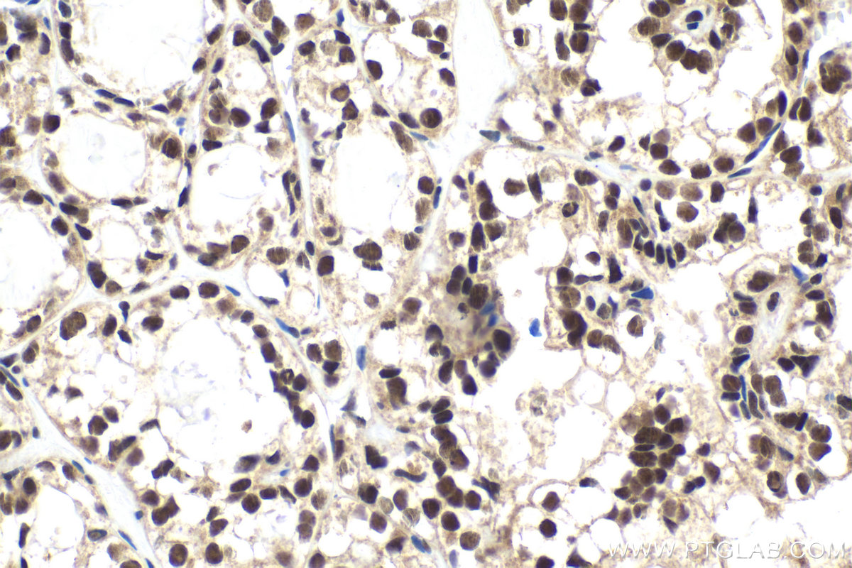 IHC staining of human thyroid cancer using 10617-1-AP