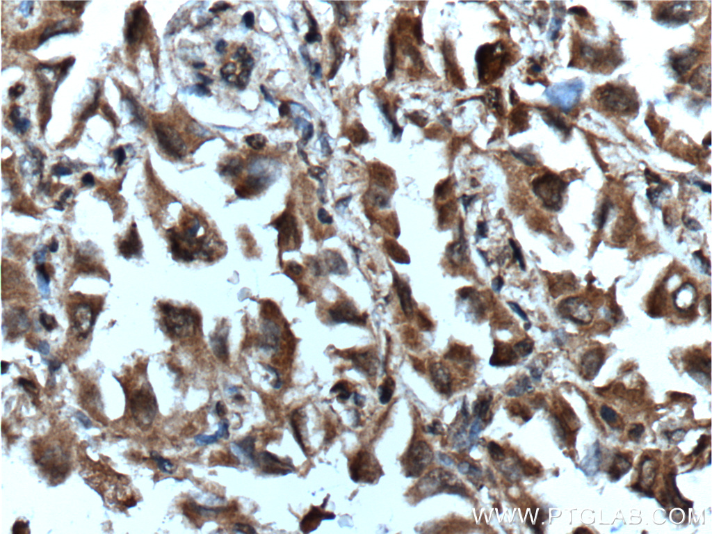 IHC staining of human lung cancer using 60352-1-Ig (same clone as 60352-1-PBS)
