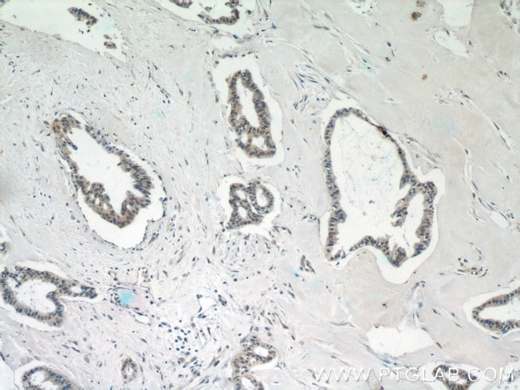 IHC staining of human breast cancer using 24793-1-AP