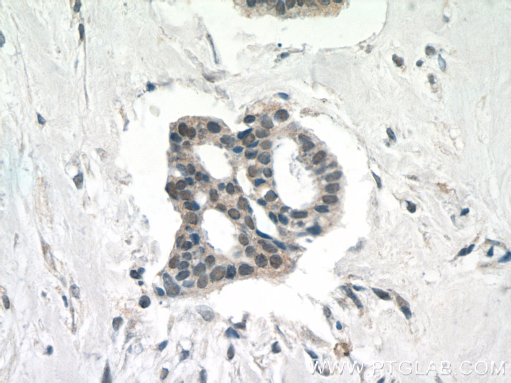 IHC staining of human breast cancer using 24793-1-AP