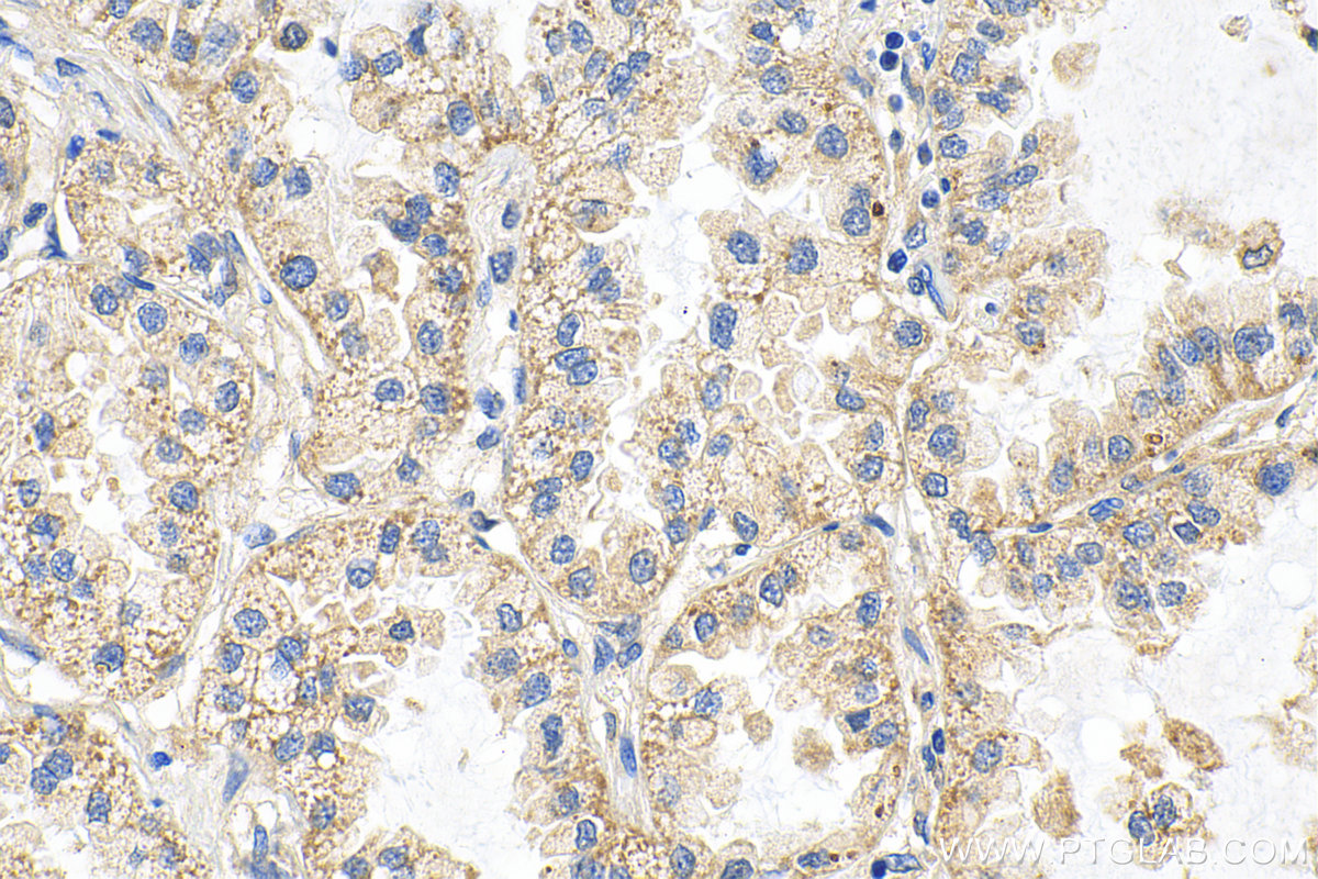 IHC staining of human lung cancer using 15890-1-AP