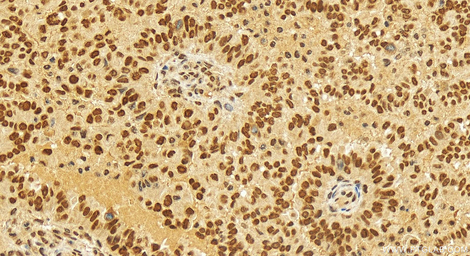 IHC staining of human ovary cancer using 16620-1-AP