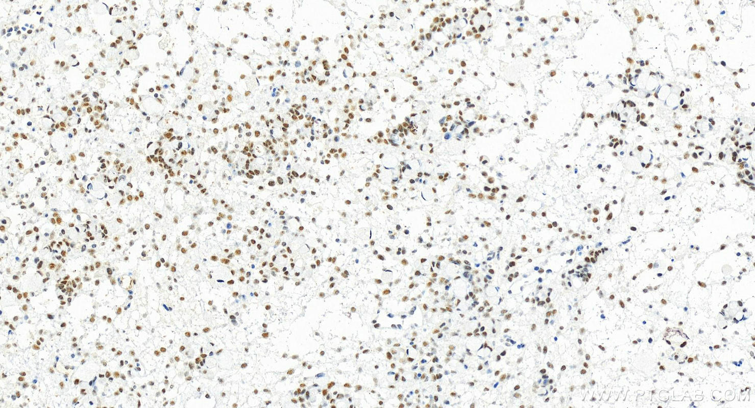 IHC staining of human ovary cancer using 83590-6-RR