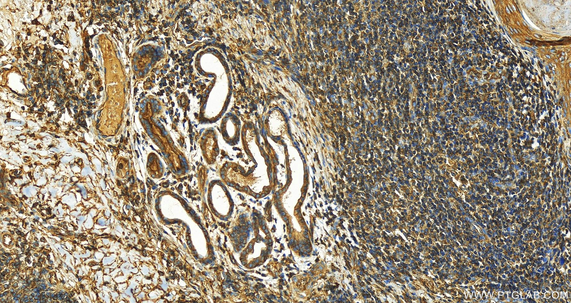 IHC staining of human skin cancer using 68588-1-Ig