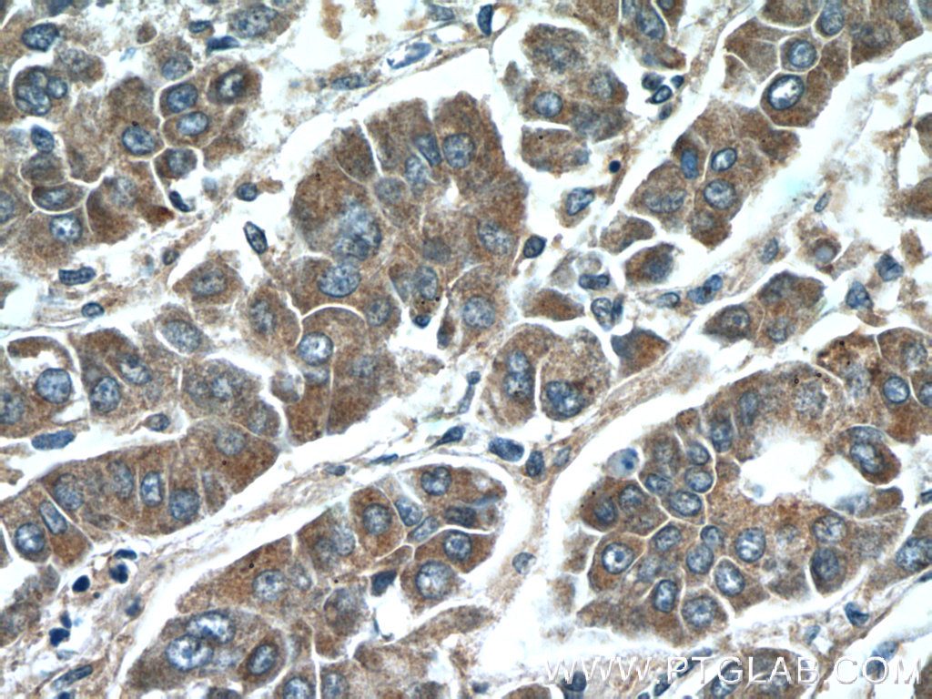 IHC staining of human liver cancer using 55189-1-AP