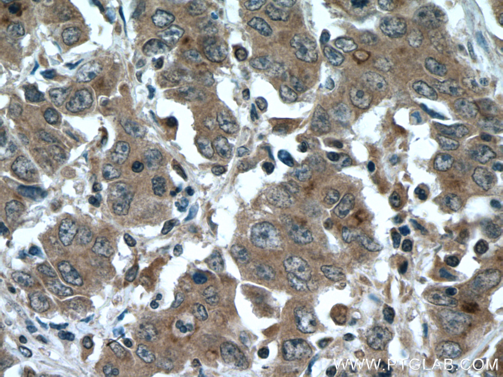 IHC staining of human stomach cancer using 25930-1-AP