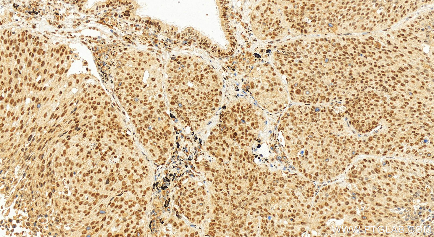 IHC staining of human lung squamous cell carcinoma using 18847-1-AP