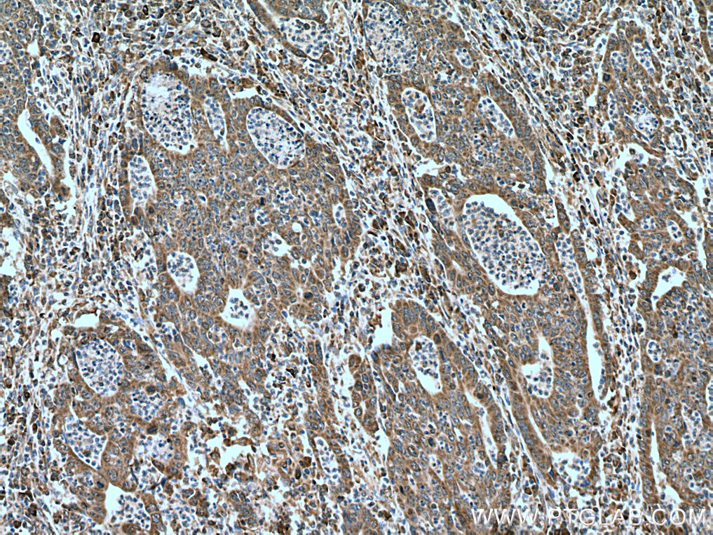 IHC staining of human colon cancer using 24440-1-AP