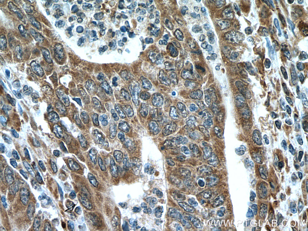 IHC staining of human colon cancer using 24440-1-AP