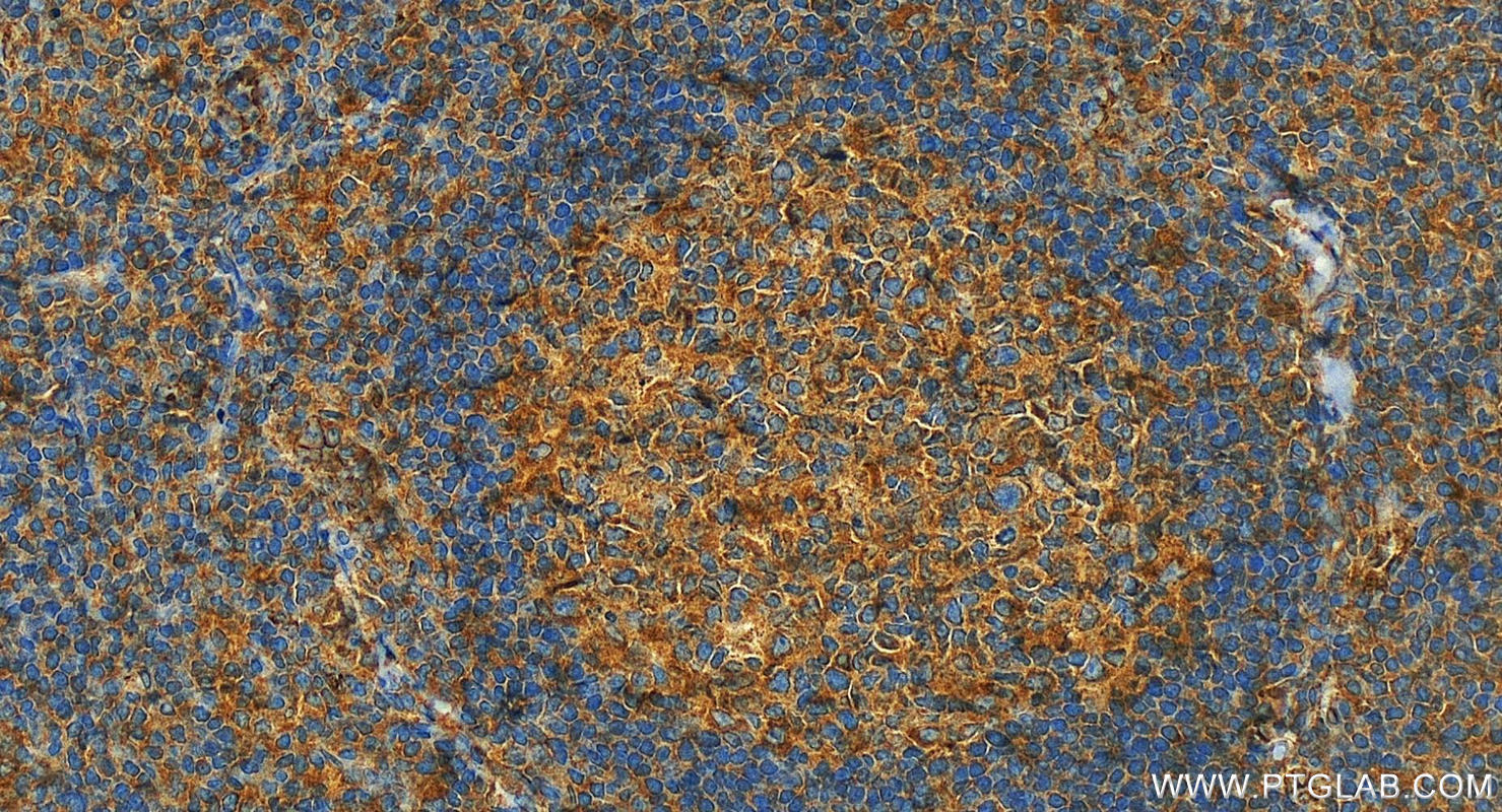 IHC staining of human tonsillitis using 19676-1-AP