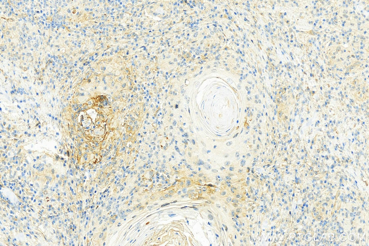 IHC staining of human skin cancer using 10569-1-AP