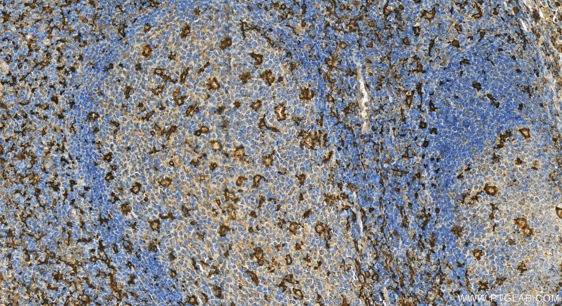 IHC staining of human tonsillitis using 17342-1-AP