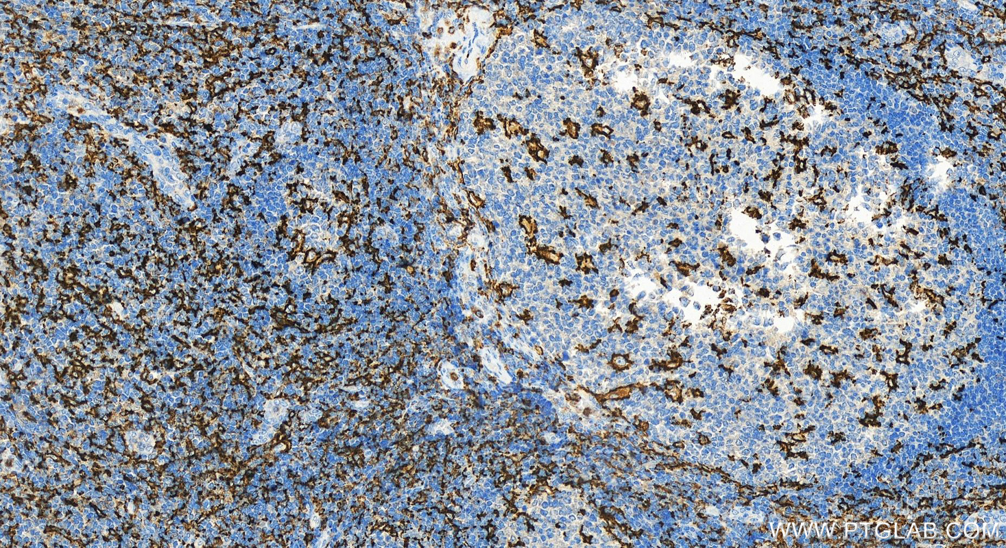 IHC staining of human tonsillitis using 17342-1-AP