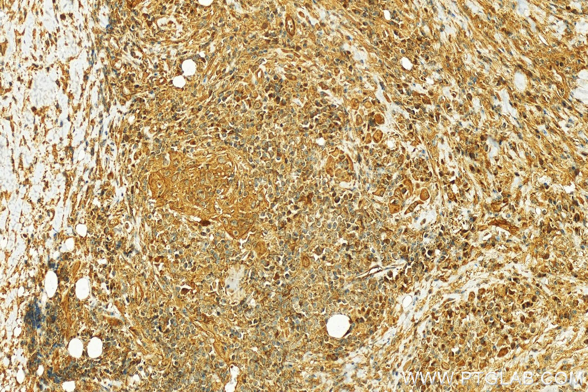 IHC staining of human skin cancer using 10743-1-AP