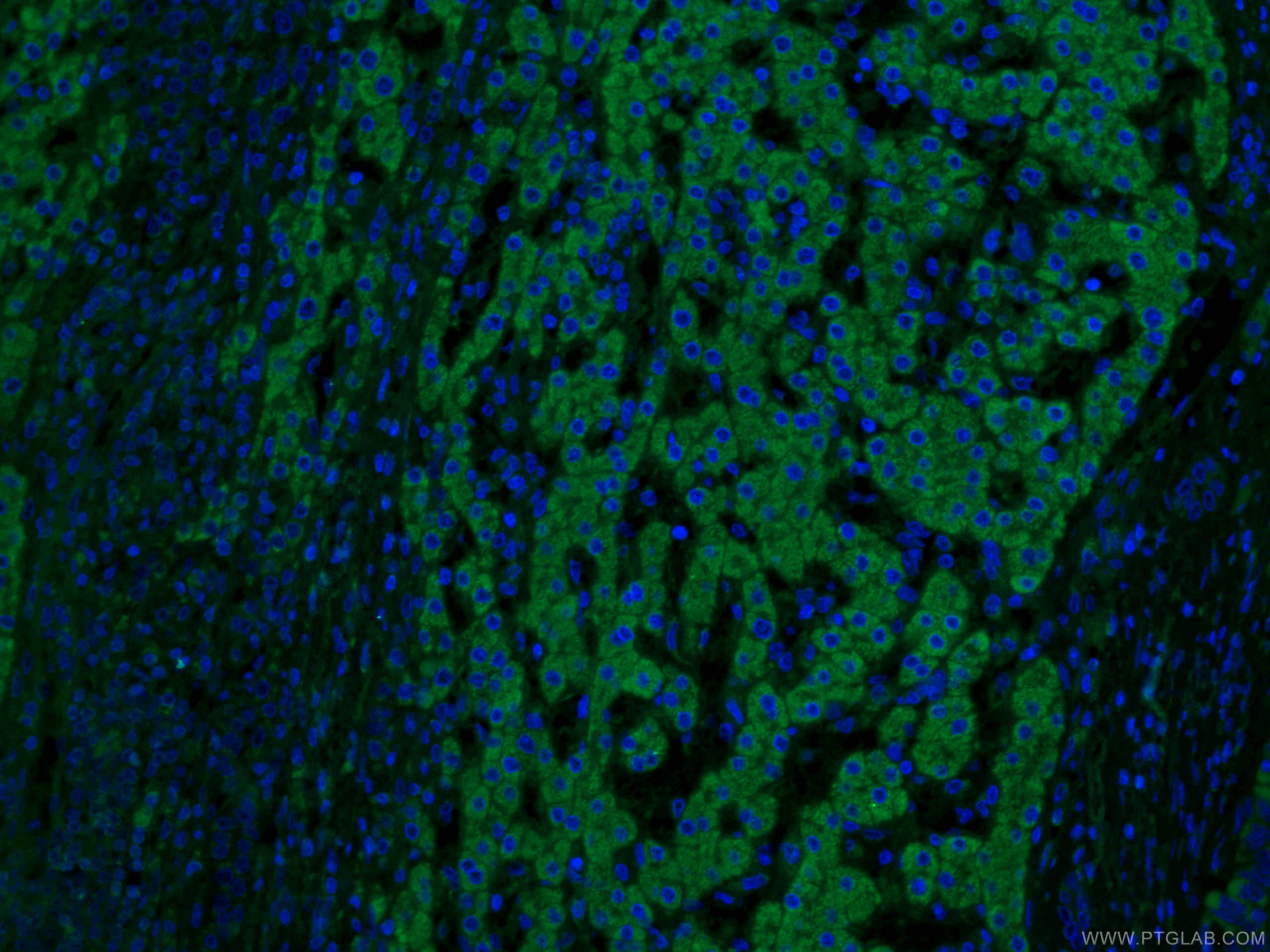 IF Staining of human liver cancer using 66032-1-Ig (same clone as 66032-1-PBS)