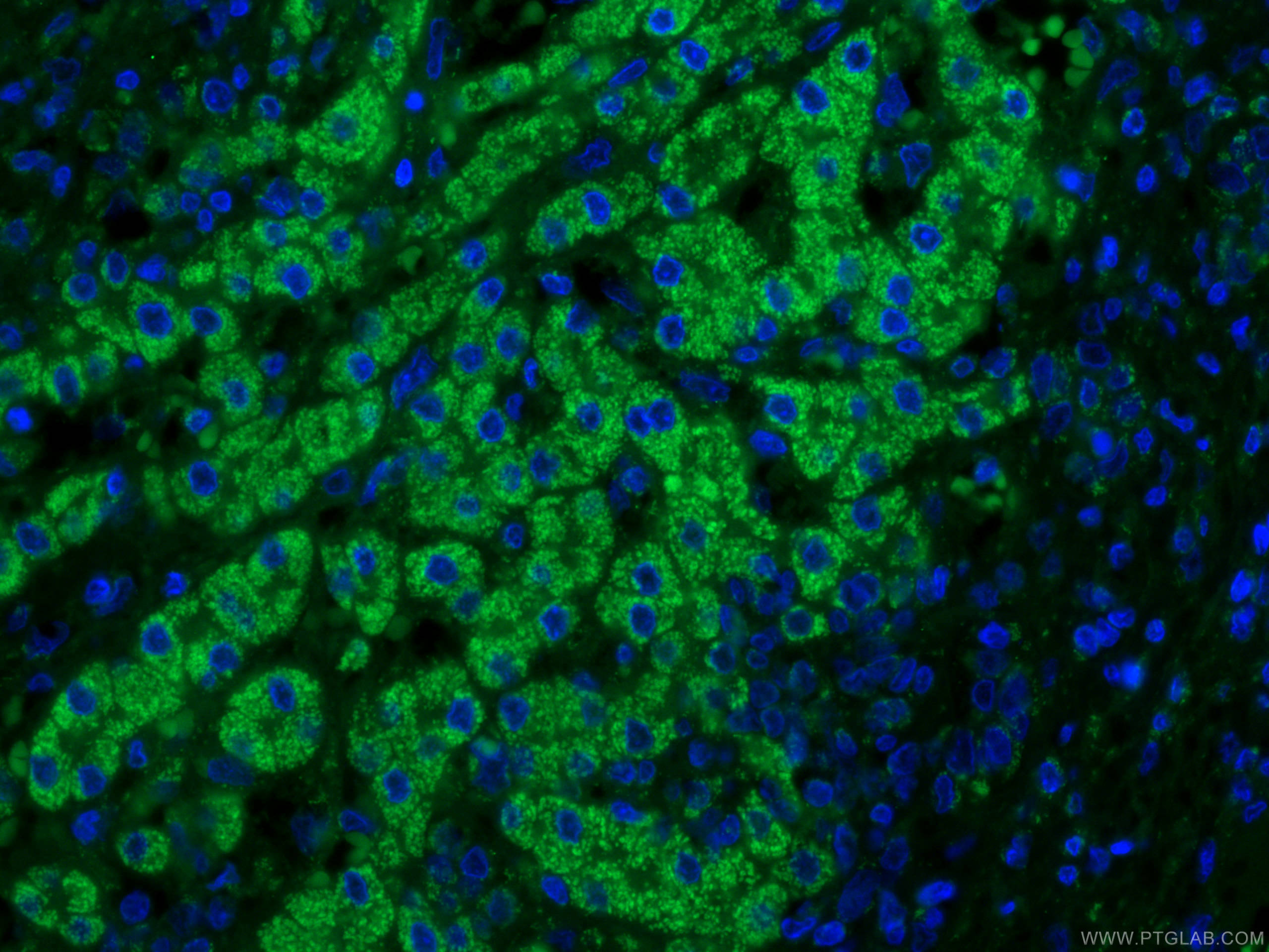 IF Staining of human liver cancer using 66032-1-Ig (same clone as 66032-1-PBS)