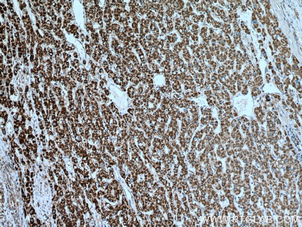 IHC staining of human liver cancer using 66032-1-Ig (same clone as 66032-1-PBS)