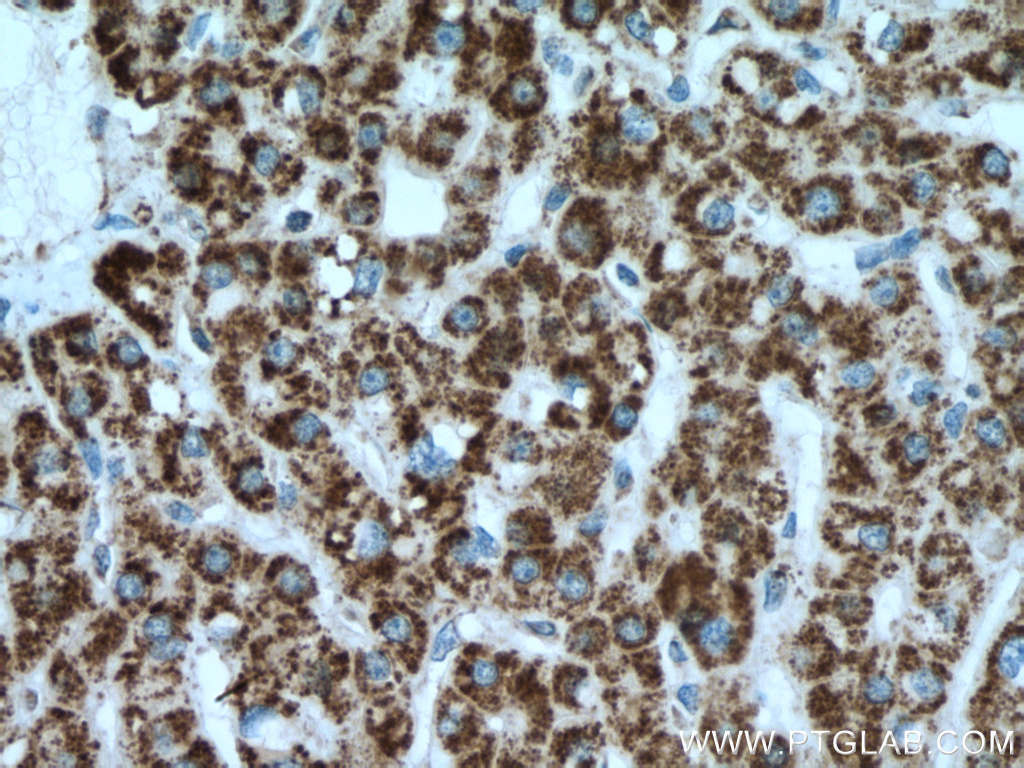 IHC staining of human liver cancer using 66032-1-Ig (same clone as 66032-1-PBS)