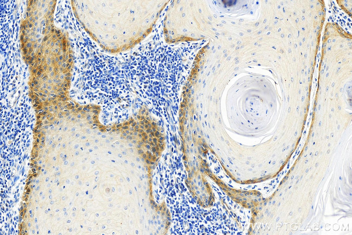 IHC staining of human skin cancer using 66922-2-Ig