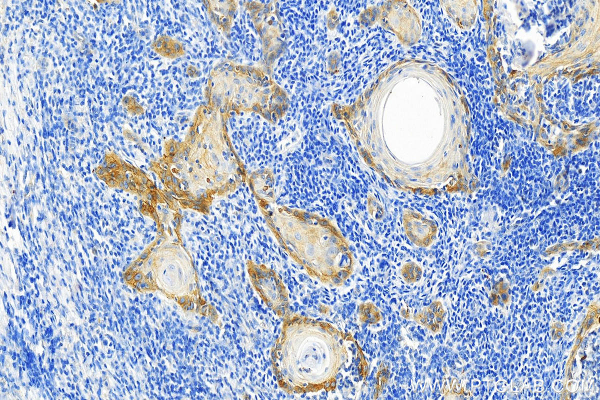 IHC staining of human skin cancer using 66922-2-Ig