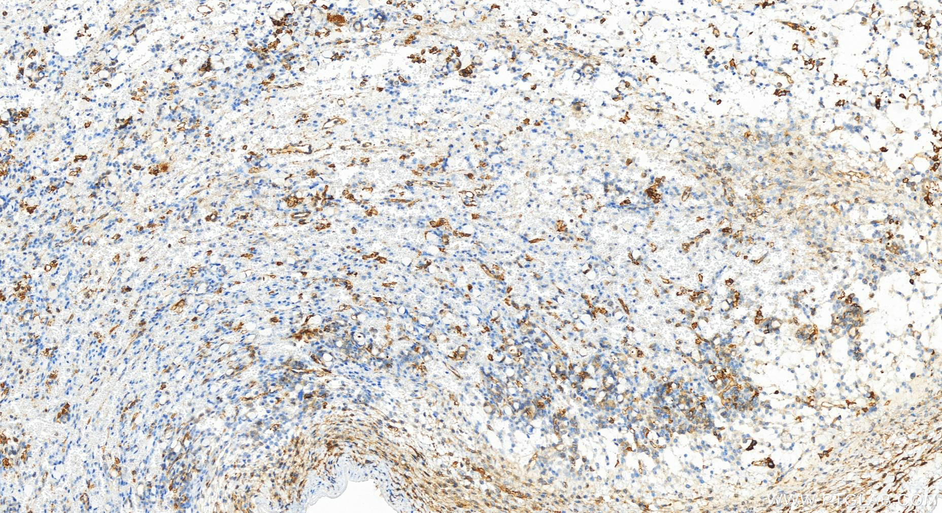 IHC staining of human ovary cancer using 83514-3-RR