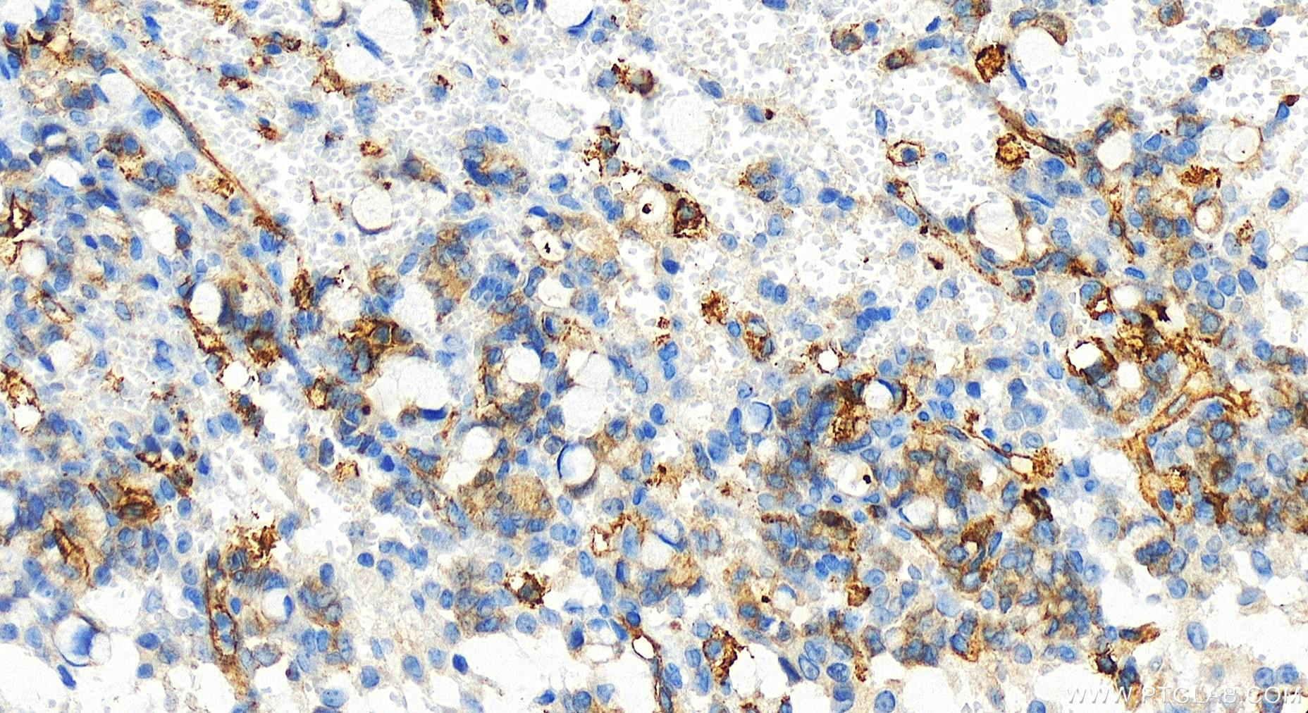 IHC staining of human ovary cancer using 83514-3-RR