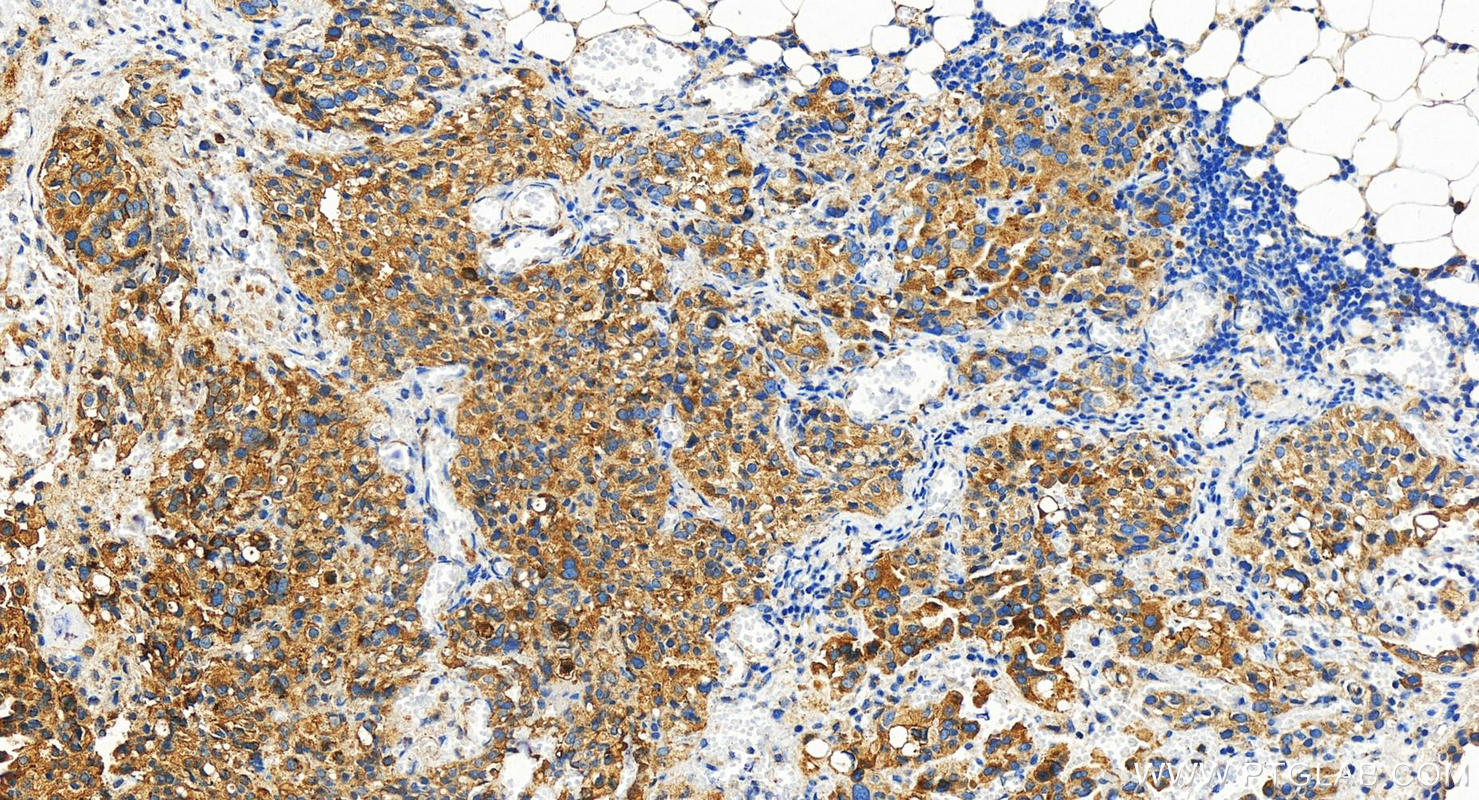 IHC staining of human ovary cancer using 29775-1-AP