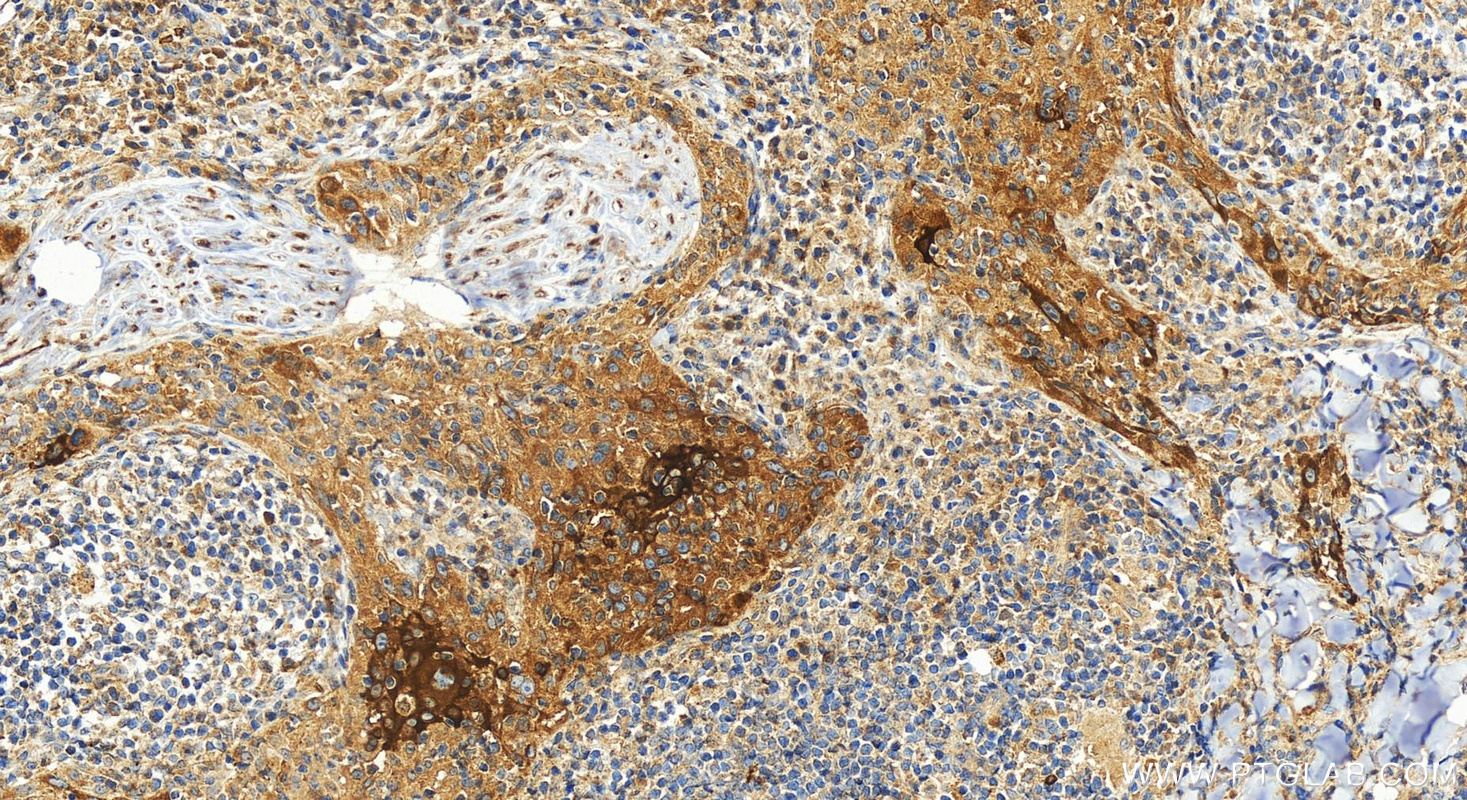 IHC staining of human skin cancer using 28462-1-AP