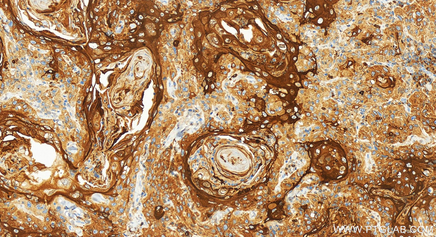 IHC staining of human skin cancer using 83649-5-RR