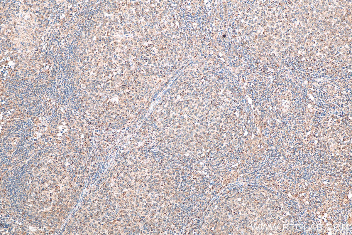 IHC staining of human lymphoma using 80331-1-RR