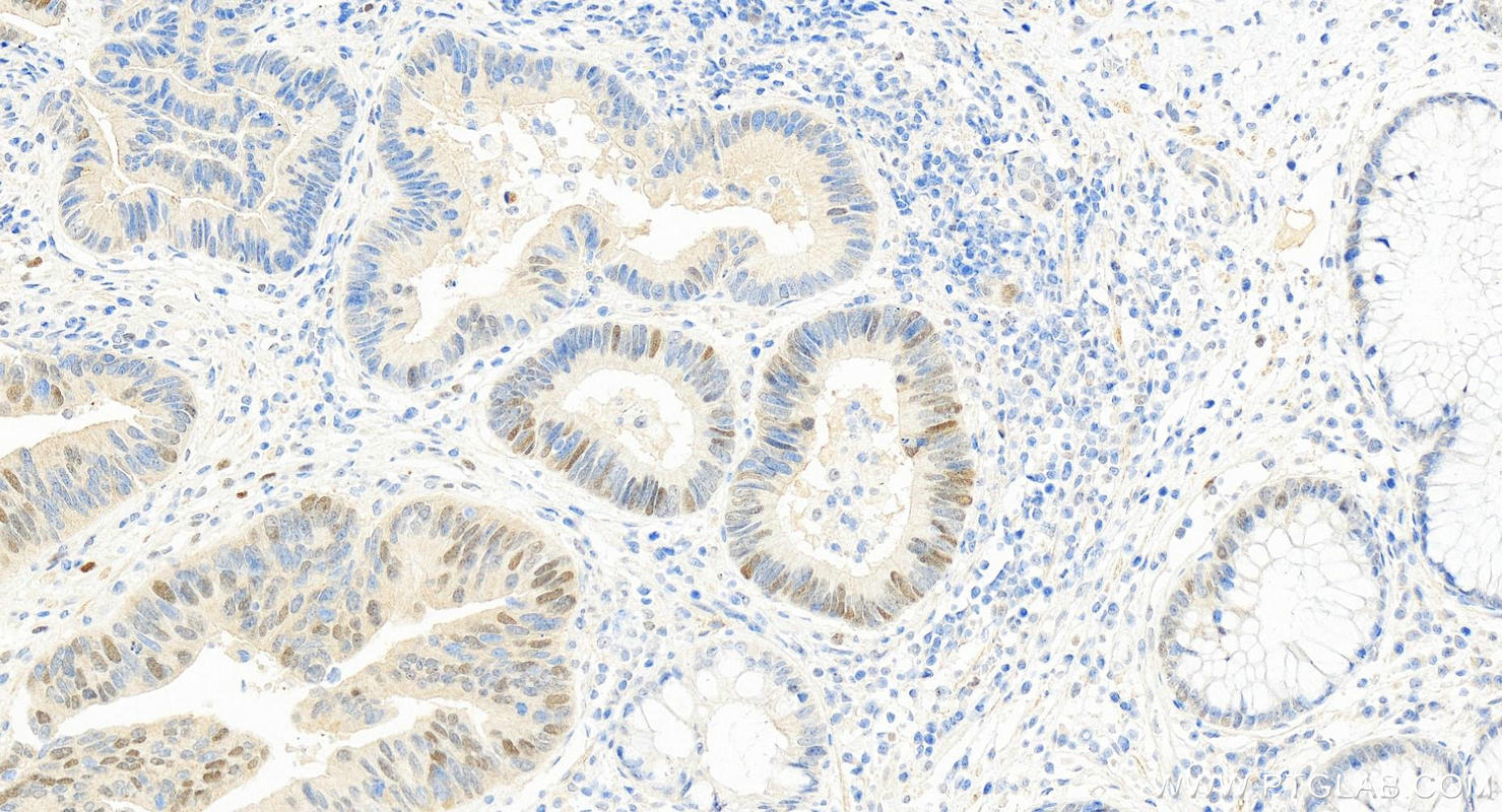 IHC staining of human colon cancer using 25098-1-AP