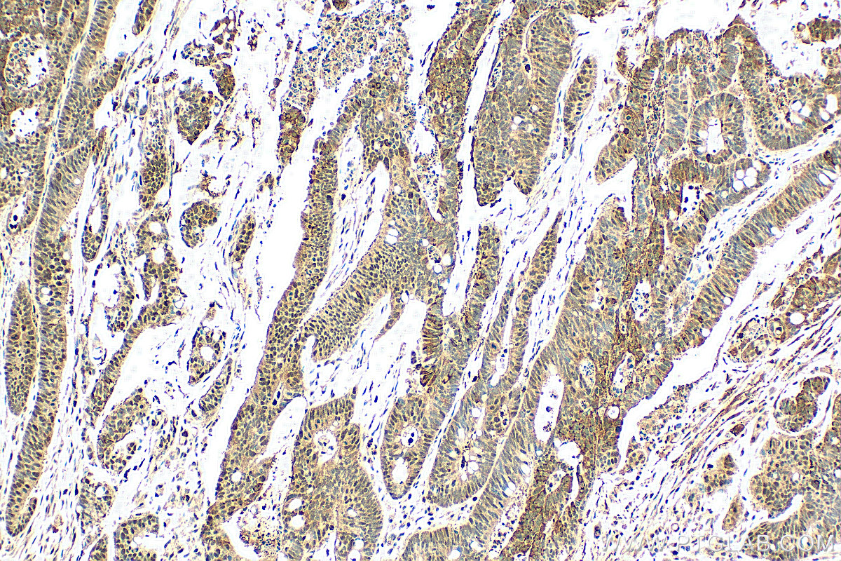 IHC staining of human colon cancer using 25098-1-AP