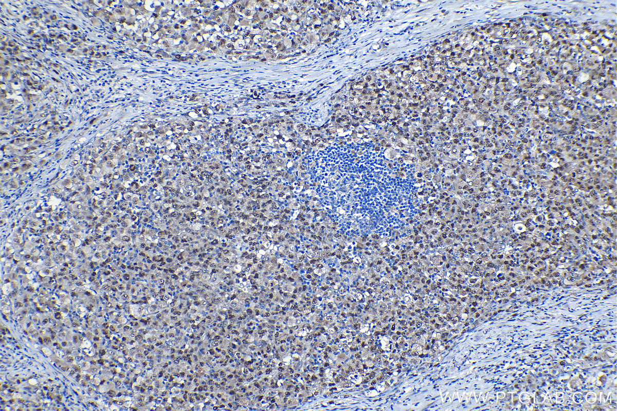 IHC staining of human lymphoma using 10486-1-AP