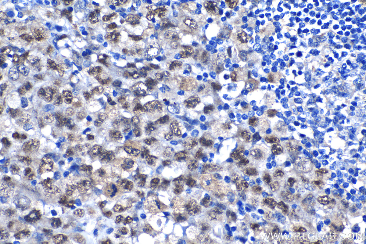 IHC staining of human lymphoma using 10486-1-AP