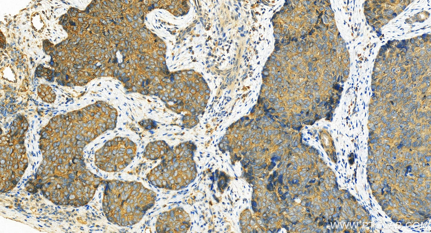 IHC staining of human bowen disease using 11146-1-AP