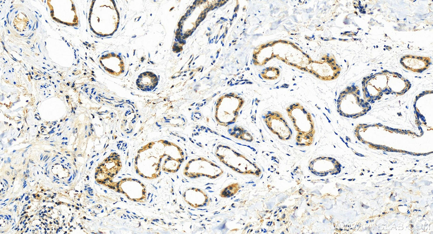 IHC staining of human bowen disease using 11146-1-AP