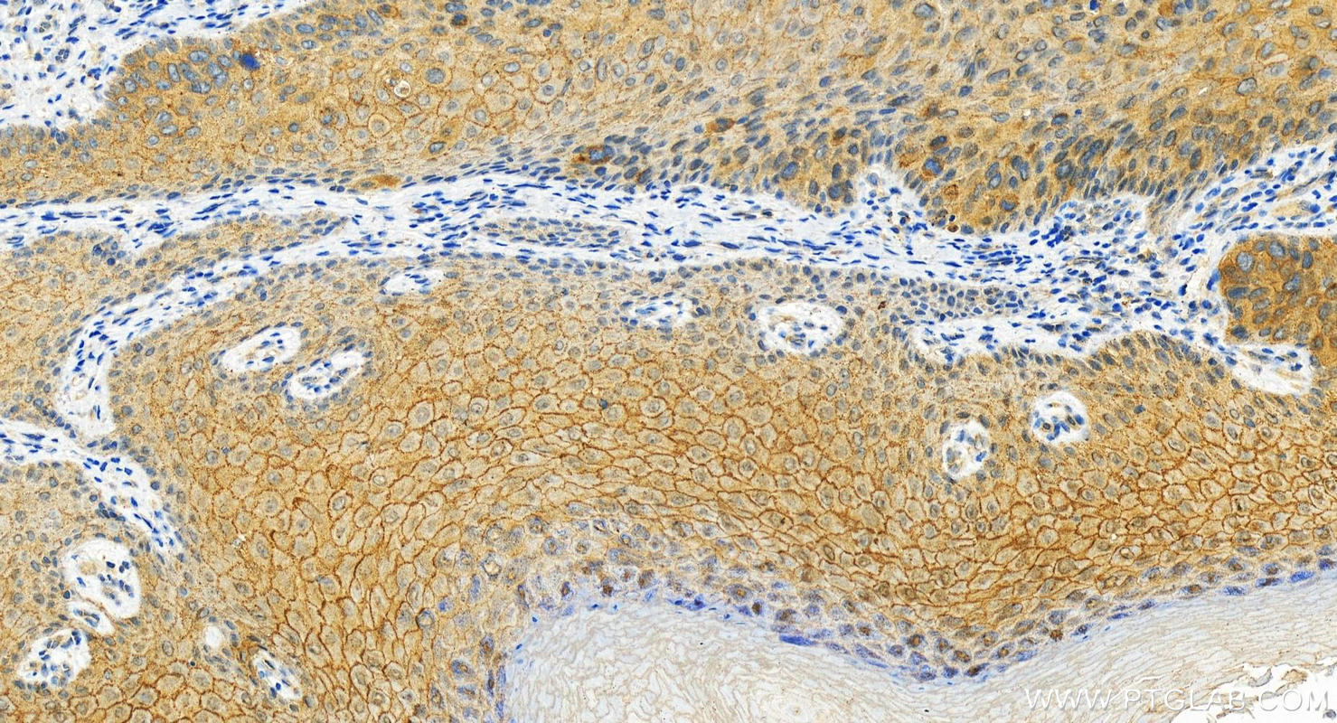 IHC staining of human bowen disease using 11146-1-AP