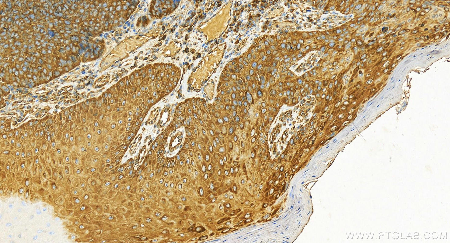 IHC staining of human brown disease using 14951-1-AP